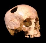 800px-Crane-trepanation-img_0507_crop.jpg