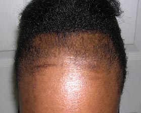 traction_alopecia-1.jpg