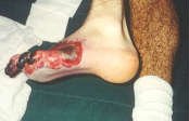 TN Brandon foot 1 - Diabetes Mellitus, Insipidus or SIADH?