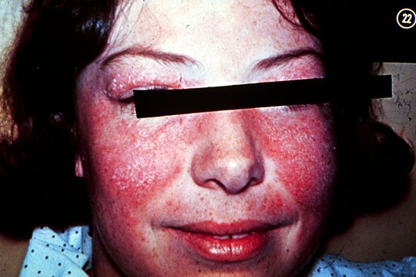 butterfly_rash-1.jpg