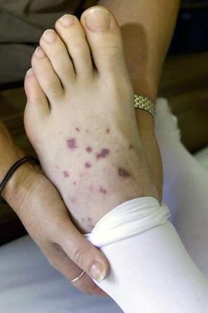 meningococcal_narrowweb__300x4520-1.jpg