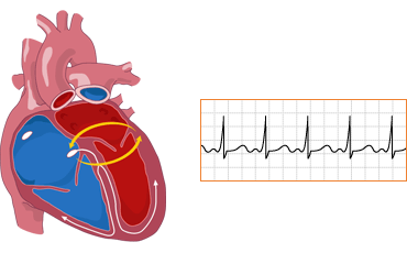 wolffparkinsonwhite 1 - The Medical student Review