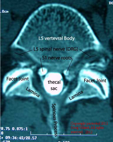 CTAxial Tuto L5Bone 1 - The Medical student Review