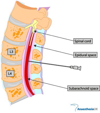 pain lumbar puncture 1 - The Medical student Review