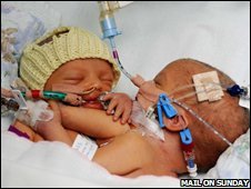 45263960 73a96dfb67ac498e817d51c5062b98 1 - Conjoined twins are born in the UK