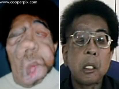facetransplant-1.jpg