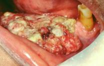 Carcinoma3Thumb-1.jpg