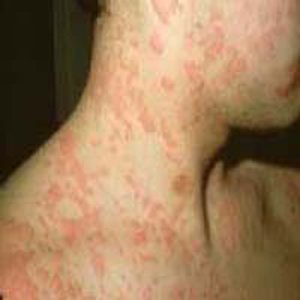 anaphylaxis-1.jpg
