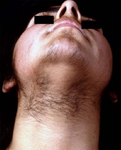 hirsutism-1.jpg