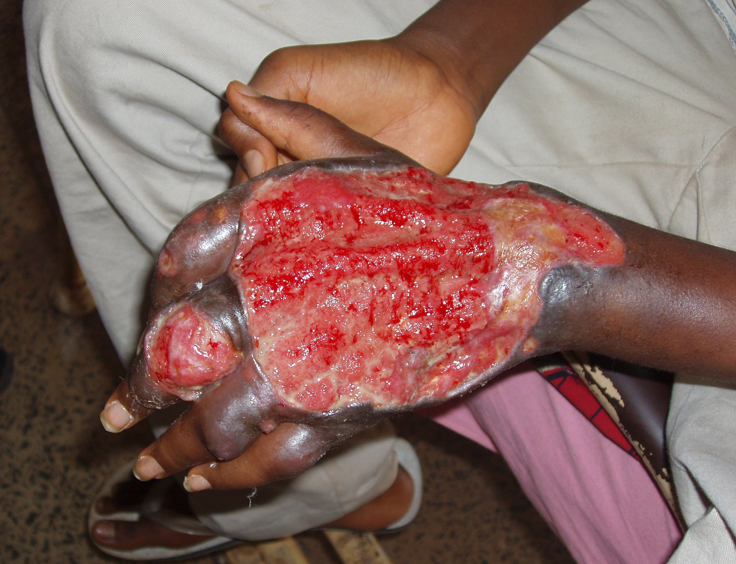 Large_ulcer_Nigeria_hand_large-1.jpg