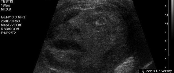 rTUMOURFACETESTICULARCANCERULTRASOUNDlar-1.jpg