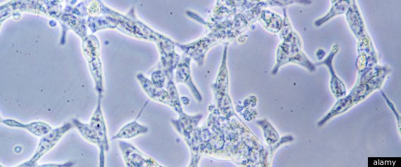 rPROSTATECANCERCIRCUMCISIONlarge570-1.jpg