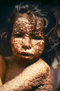 230pxChild_with_Smallpox_Bangladesh-1.jpg