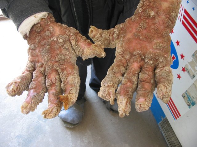 EasternEuropeanSkinCondition7-1.jpg
