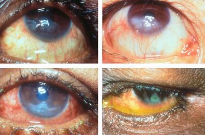 Keratitis-1.jpg