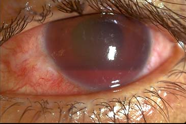 hyphema-1.jpg