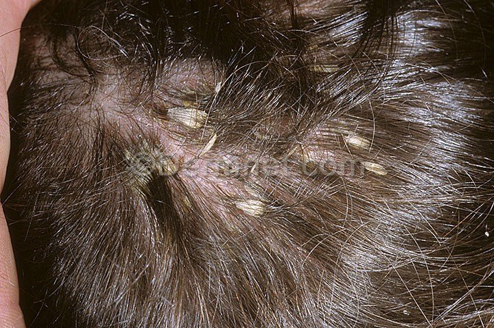 psoriasisscalp29-1.jpg