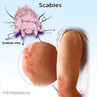 scabieswhatiscausess2-1.jpg
